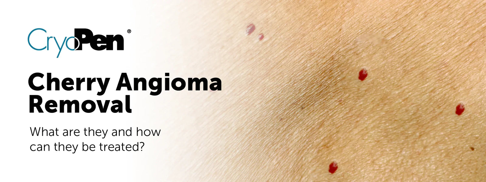 Cherry Angioma Removal: What Are They and How Can They Be Treated?