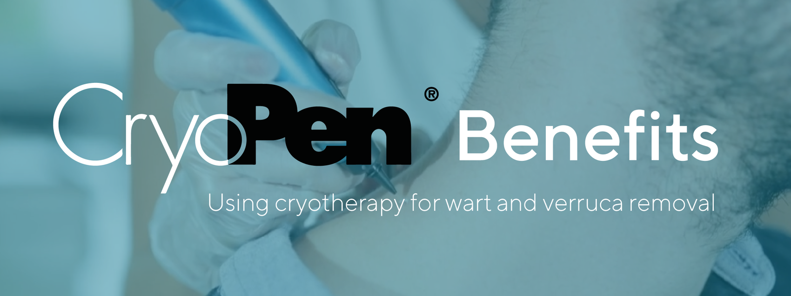 Cryopen Wart Removal: Using Cryotherapy for Wart Removal