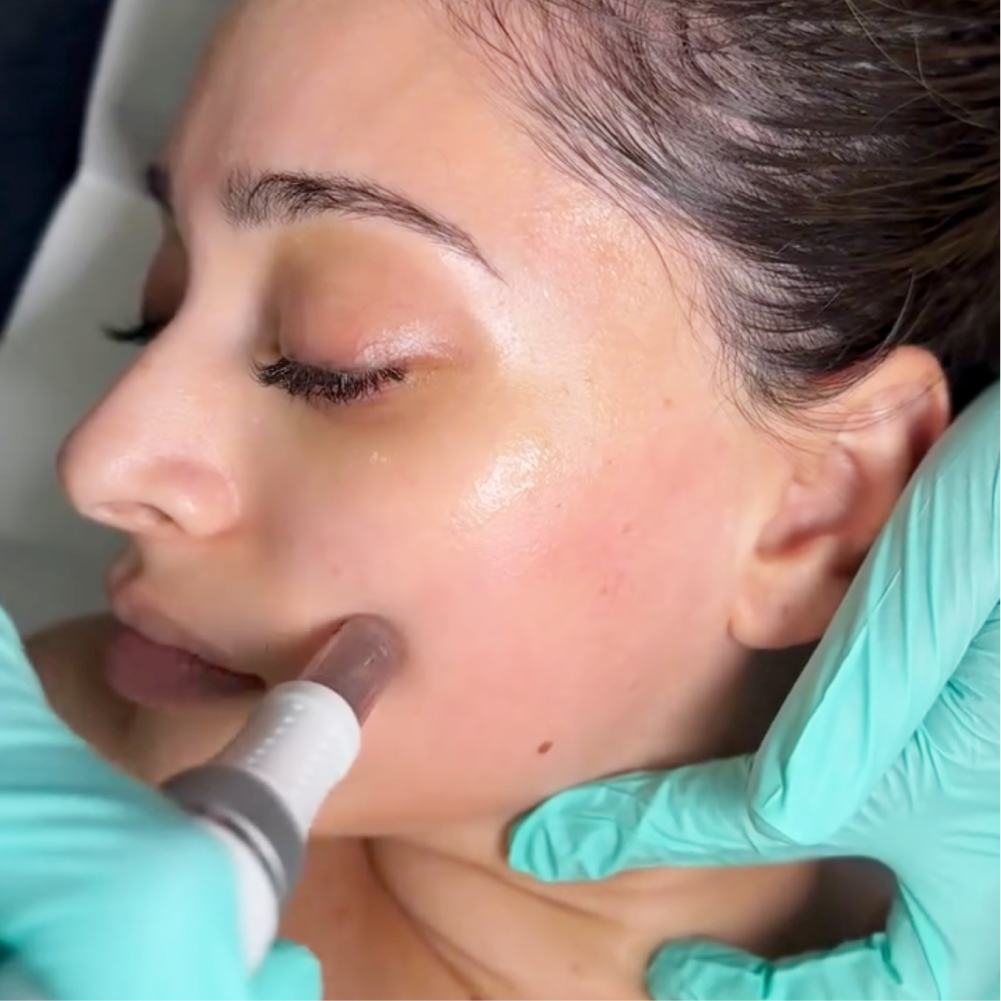 facial treatment with imedpen device by a nurse