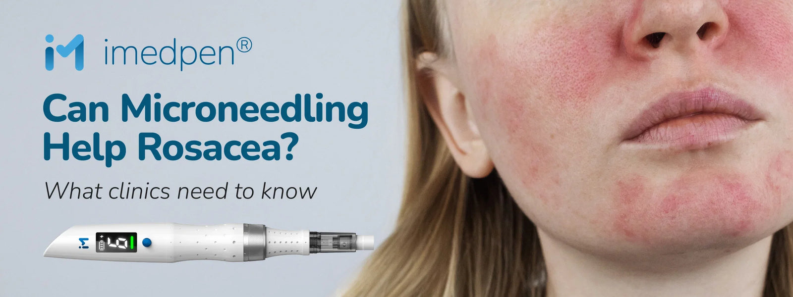 Can Microneedling Help Rosacea? What Clinics Need To Know