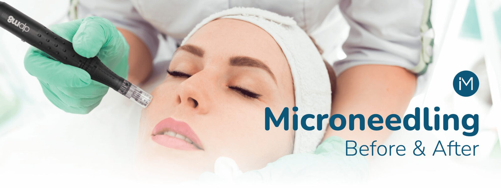 Microneedling Before and After: All You Need To Know