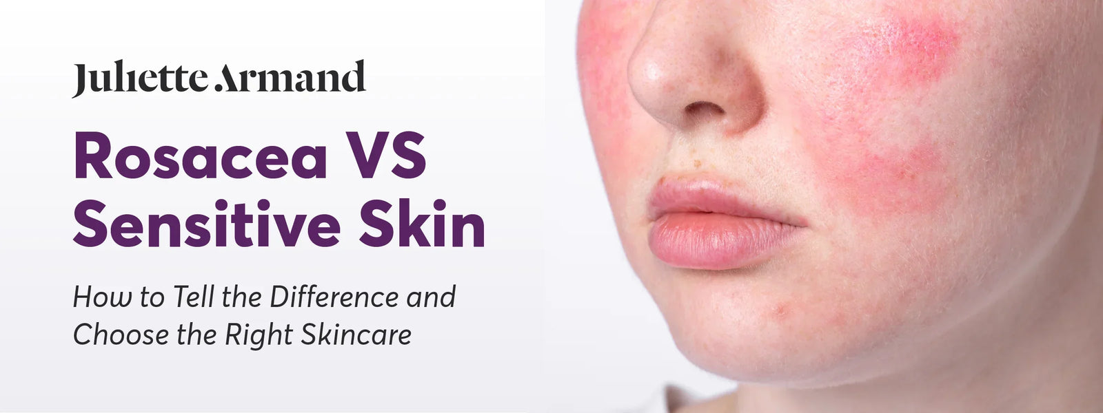 Rosacea vs Sensitive Skin: How To Tell the Difference and Choose the Right Skincare
