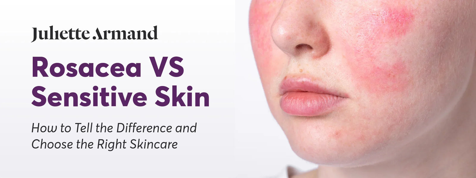 Rosacea vs Sensitive Skin: How To Tell the Difference and Choose the Right Skincare