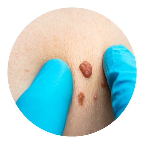 Skin Tag Removal: What, Why, and Insights For Clinic Owners