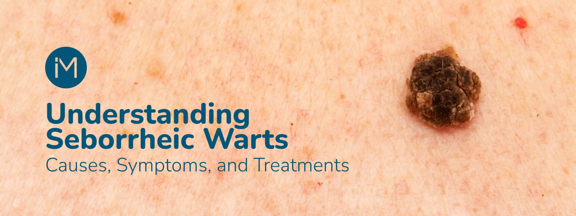 Understanding Seborrheic Warts: Causes, Symptoms and Treatments - IvanMed