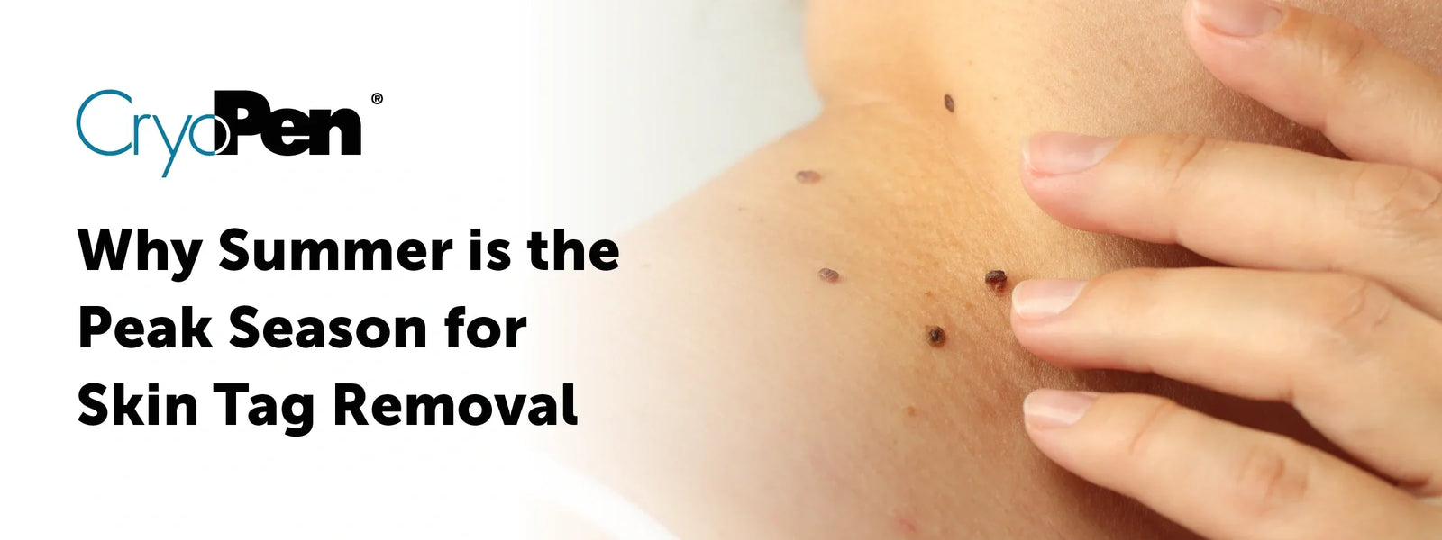 Why Summer Can Be Peak Season for Skin Tag Removal With CryoPen®