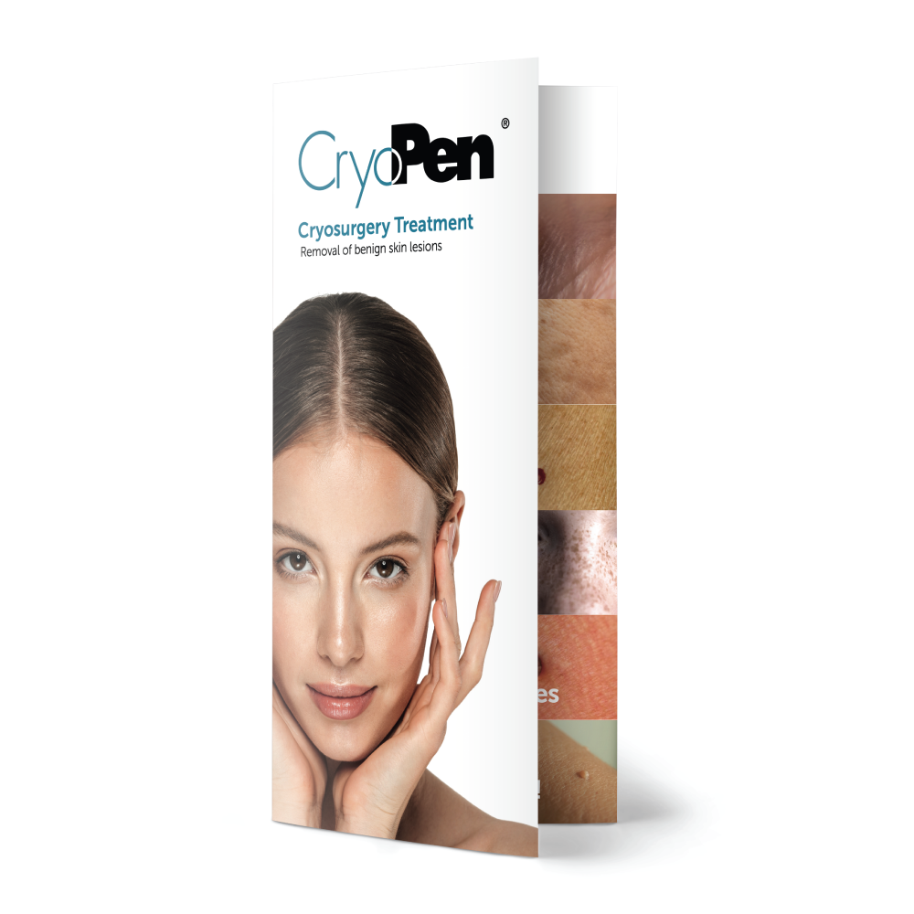 CryoPen® Treatment Flyers