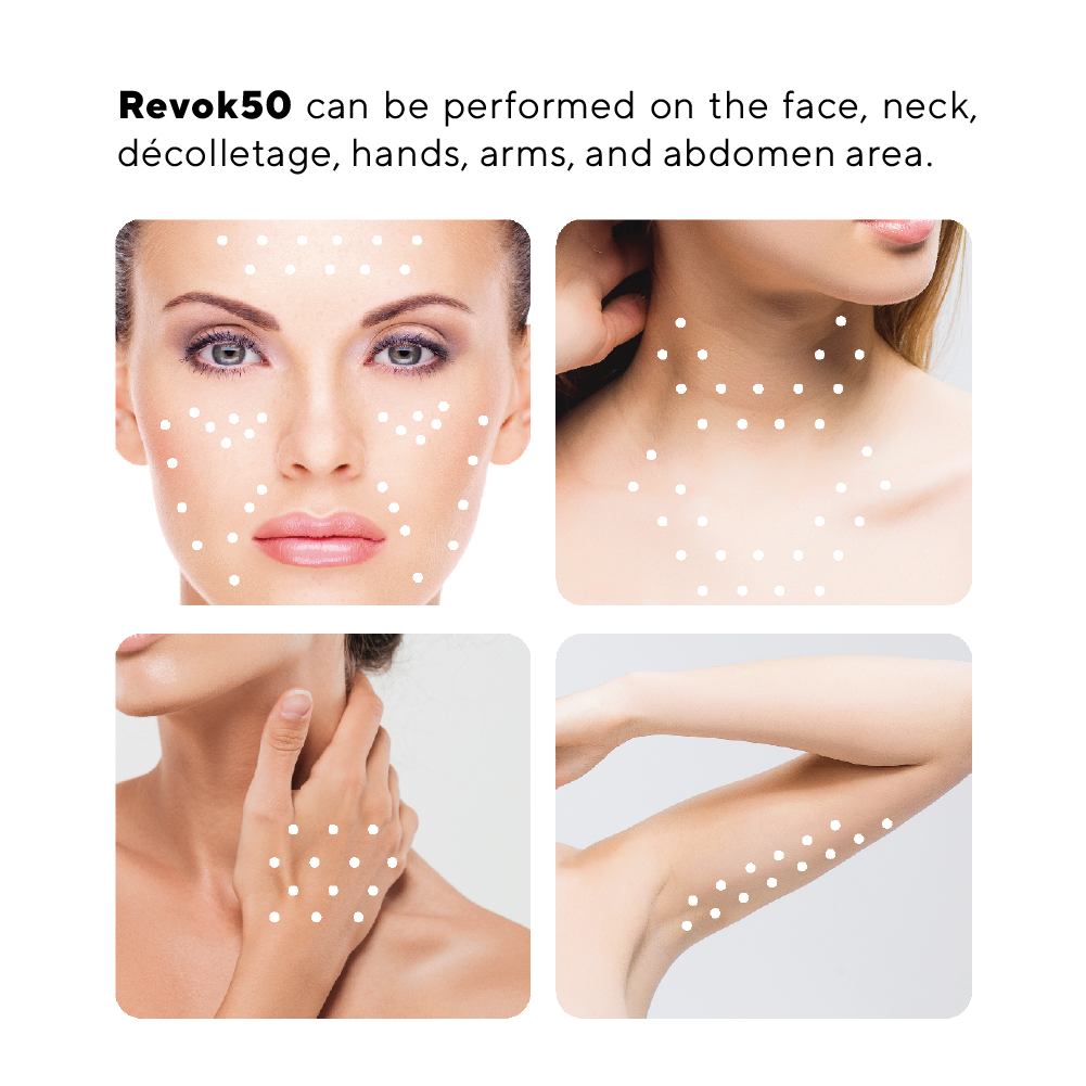 Revok50 Injectable Hyaluronic Acid - IvanMed